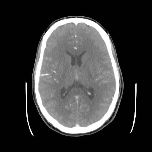 Cerebral arteriovenous malformation (Spetzler-Martin grade 2) (Radiopaedia 41262-44076 Axial C+ 28).png