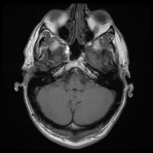 File:Cerebral arteriovenous malformation (Spetzler-Martin grade 2) (Radiopaedia 41262-44092 Axial T1 3).png