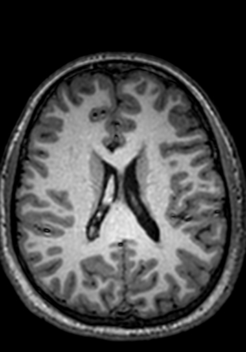 Cerebral arteriovenous malformation at posterior body of corpus callosum (Radiopaedia 74111-84925 Axial T1 111).jpg