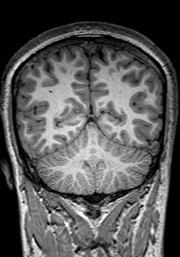 Cerebral arteriovenous malformation at posterior body of corpus callosum (Radiopaedia 74111-84925 Coronal T1 256).jpg