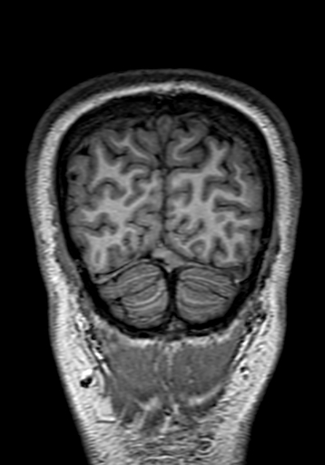 Cerebral arteriovenous malformation at posterior body of corpus callosum (Radiopaedia 74111-84925 Coronal T1 315).jpg