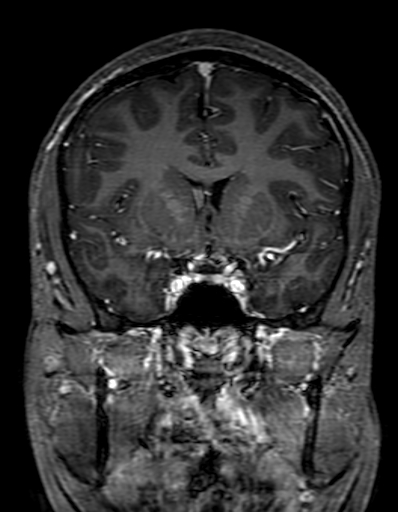 Cerebral arteriovenous malformation at posterior body of corpus callosum (Radiopaedia 74111-84925 K 139).jpg