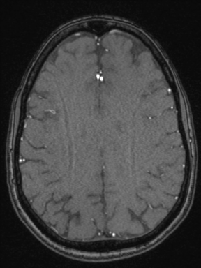Cerebral arteriovenous malformation with hemorrhage (Radiopaedia 34422-35737 Axial MRA 58).png