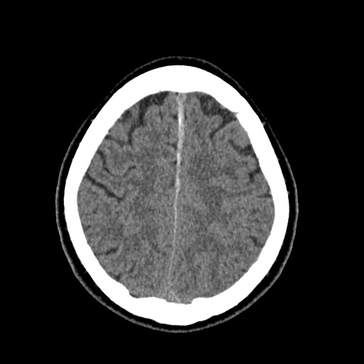 Cerebral arteriovenous malformation with lobar hemorrhage (Radiopaedia 35598-37117 Axial non-contrast 44).jpg