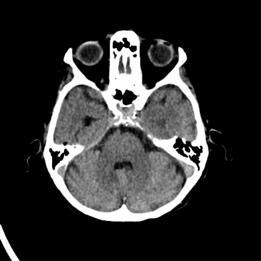 File:Cerebral arteriovenous malformation with lobar hemorrhage (Radiopaedia 44725-48510 Axial non-contrast 15).png