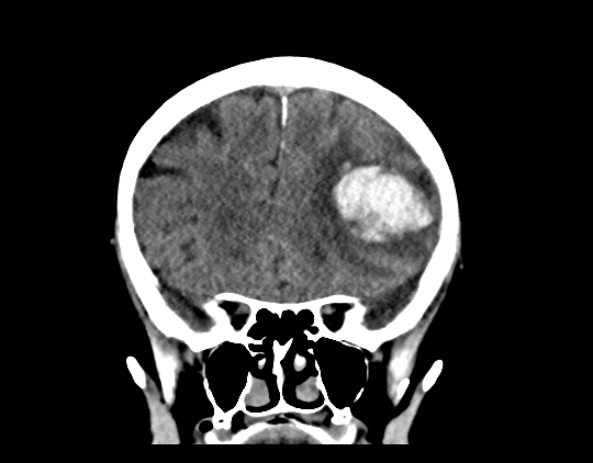 Cerebral arteriovenous malformation with lobar hemorrhage (Radiopaedia 44725-48510 Coronal non-contrast 18).png