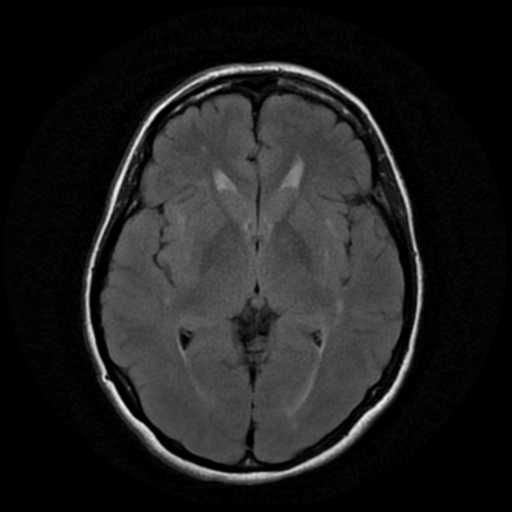 File:Cerebral autosomal dominant arteriopathy with subcortical infarcts and leukoencephalopathy (CADASIL) (Radiopaedia 41018-43768 AX FLAIR (Propeller) 10).png