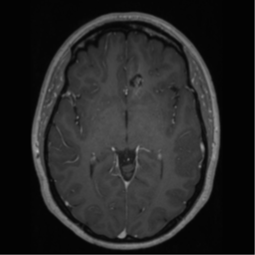 File:Cerebral cavernoma and development venous anomaly (Radiopaedia 37603-39482 Axial T1 C+ 36).png