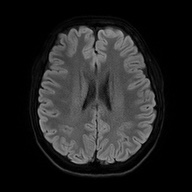 Cerebral cavernous venous malformation (Radiopaedia 70008-80021 Axial DWI 50).jpg