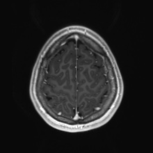 Cerebral cavernous venous malformation (Radiopaedia 70008-80021 Axial T1 C+ 87).jpg