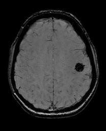 Cerebral cavernous venous malformation (Radiopaedia 70008-80021 I 52).jpg