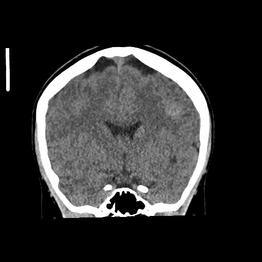 Cerebral cavernous venous malformation (Radiopaedia 70008-80022 non-contrast 31).jpg