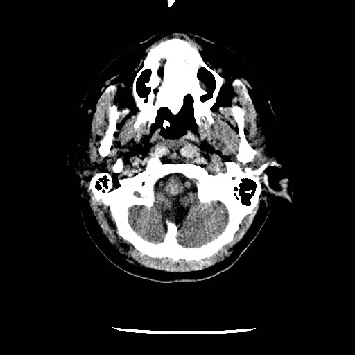 File:Cerebral edema (evolution in time) (Radiopaedia 19418-19441 non-contrast 9).jpg