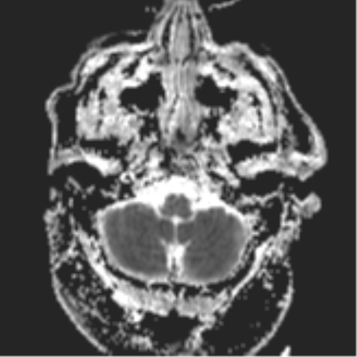 File:Cerebral embolic infarcts (embolic shower) (Radiopaedia 57395-64342 Axial ADC 6).png