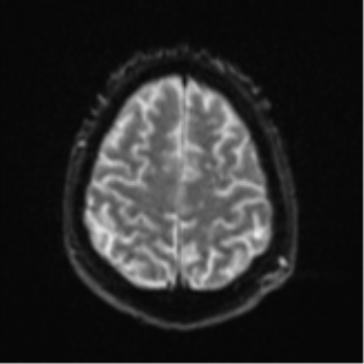 Cerebral embolic infarcts (embolic shower) (Radiopaedia 57395-64342 Axial DWI 29).png