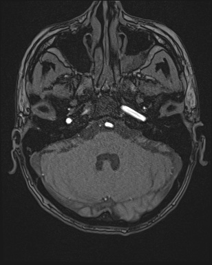 Cerebral embolic infarcts (embolic shower) (Radiopaedia 72391-82921 Axial MRA 20).jpg