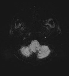 Cerebral embolic infarcts (embolic shower) (Radiopaedia 72391-82921 Axial SWI 8).jpg