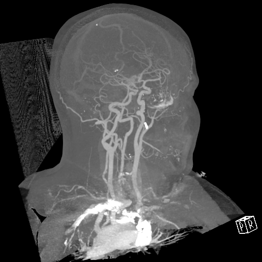 File:Cerebral hemorrhage secondary to arteriovenous malformation (Radiopaedia 33497-34571 A 33).png