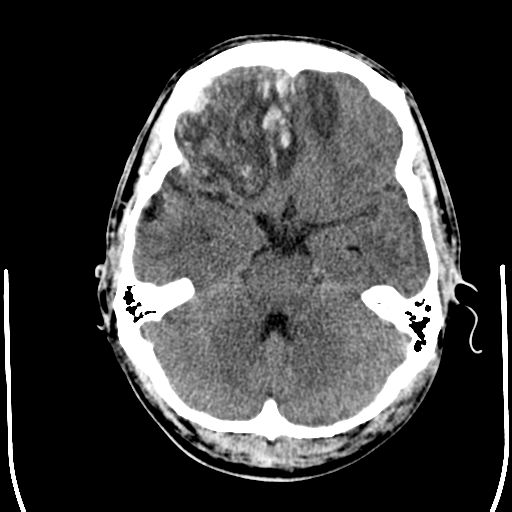 File:Cerebral hemorrhagic contusions- temporal evolution (Radiopaedia 40224-42754 Axial non-contrast 8).png