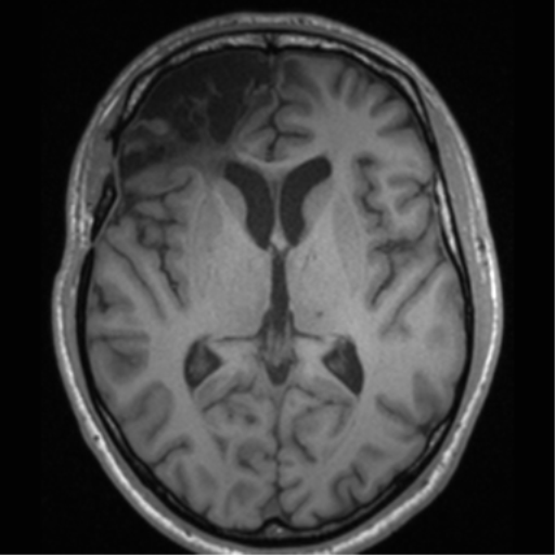 Cerebral hemorrhagic contusions- temporal evolution (Radiopaedia 40224-42757 Axial T1 39).png