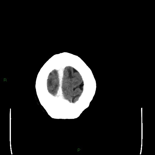 File:Cerebral metastases - breast primary (Radiopaedia 77653-89857 Axial C+ delayed 109).jpg