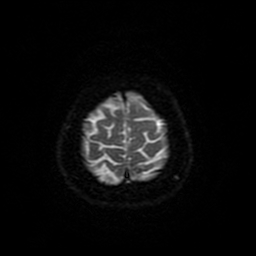 Cerebral metastases - melanoma (Radiopaedia 80972-94522 Axial DWI 91).jpg