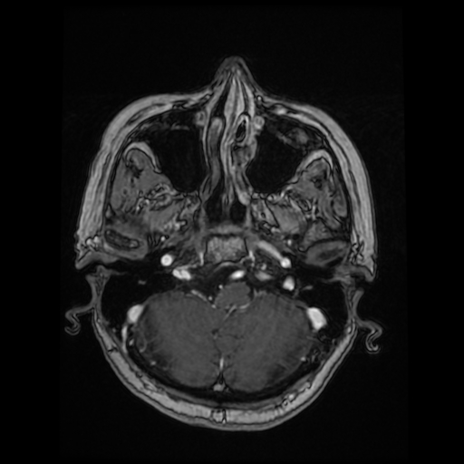 Cerebral metastases - melanoma (Radiopaedia 80972-94522 Axial T1 C+ 32).jpg