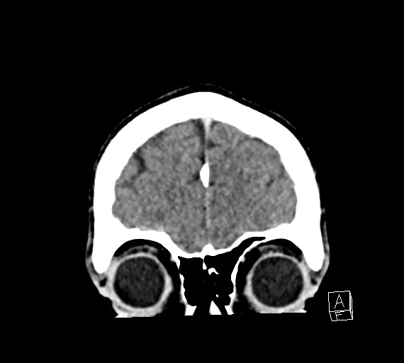 Cerebral metastases - testicular choriocarcinoma (Radiopaedia 84486-99855 D 10).jpg