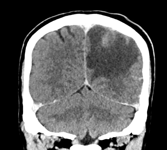 Cerebral metastases - testicular choriocarcinoma (Radiopaedia 84486-99855 D 47).jpg