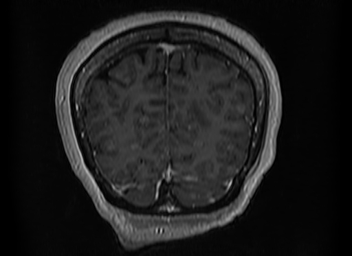 Cerebral metastases from lung cancer with amyloid angiopathy and cerebellopontine angle meningioma (Radiopaedia 74306-85191 Coronal T1 C+ 51).jpg