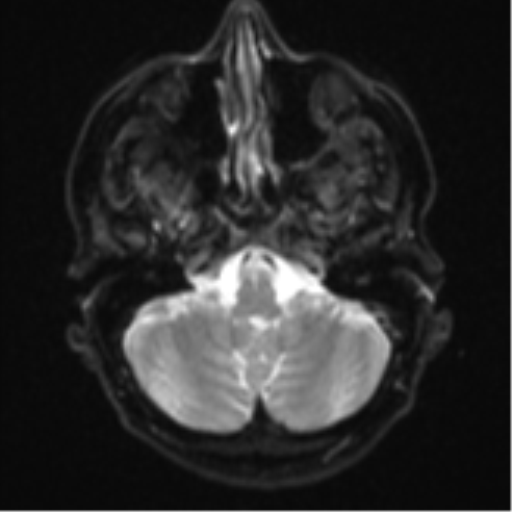Cerebral metastasis - colorectal adenocarcinoma (Radiopaedia 50394-55765 Axial DWI 4).png