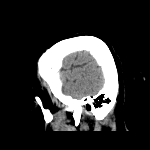 Cerebral metastasis to basal ganglia (Radiopaedia 81568-95412 E 51).png