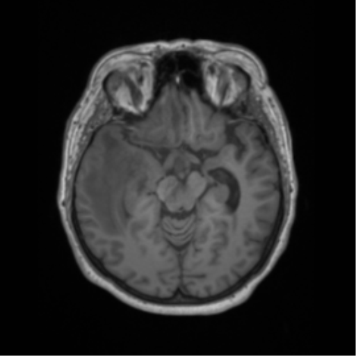 Cerebral metastasis to basal ganglia (Radiopaedia 81568-95413 Axial T1 28).png
