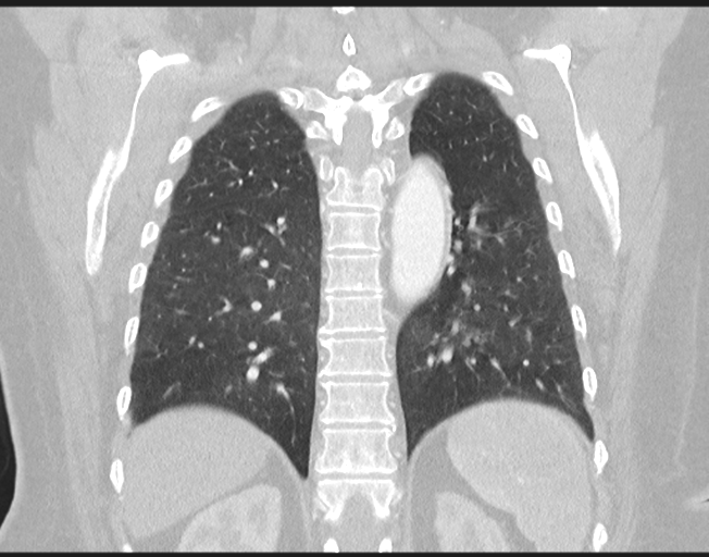 File:Cerebral metastasis to basal ganglia (Radiopaedia 81568-95414 Coronal lung window 63).png