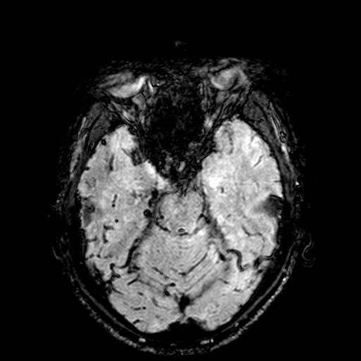 Cerebral parenchymal arteriovenous malformation (Radiopaedia 27280-27456 Axial SWI 33).jpg