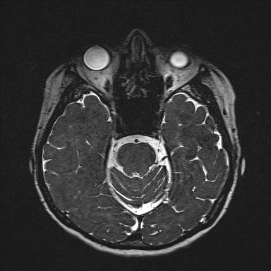 Cerebral ring enhancing lesions - cerebral metastases (Radiopaedia 44922-48817 F 57).jpg