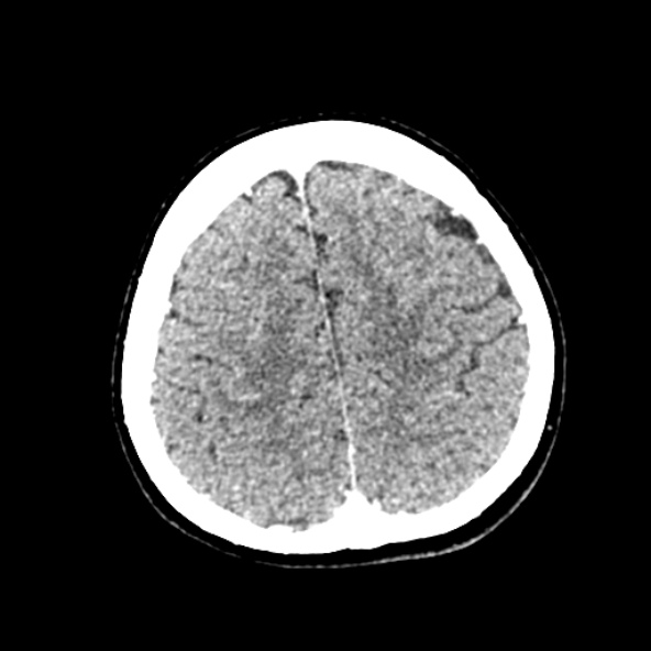 Cerebral ring enhancing lesions - cerebral metastases (Radiopaedia 44922-48818 B 222).jpg