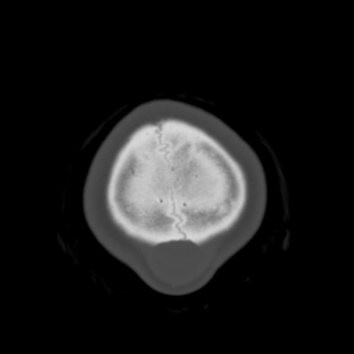 Cerebral tuberculosis with dural sinus invasion (Radiopaedia 60353-68018 Axial bone window 64).jpg