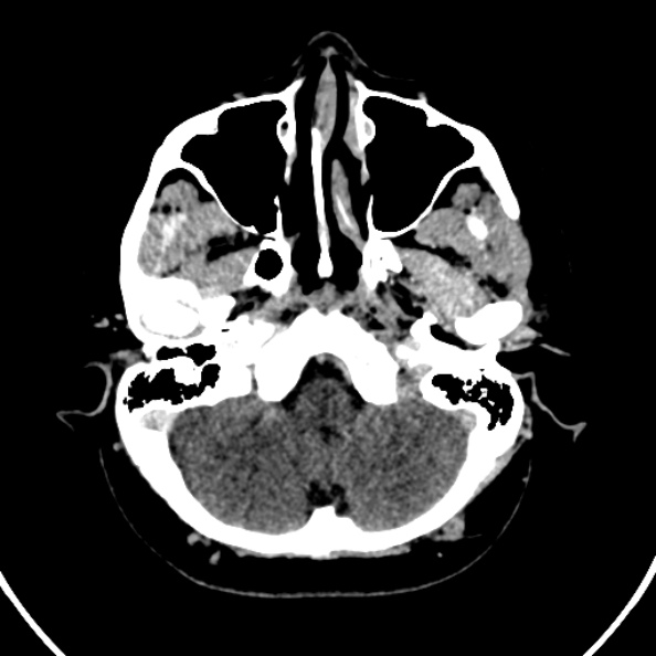 File:Cerebral venous hemorrhagic infarct from venous sinus thrombosis (Radiopaedia 55433-61883 Axial C+ delayed 125).jpg