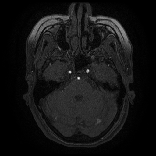 Cerebral venous infarction (Radiopaedia 25109-25363 MRA 21).jpg