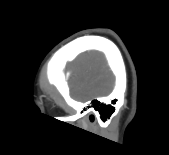 File:Cerebral venous infarction due to transverse sinus thrombosis (Radiopaedia 34688-36120 Sagittal CT venogram 47).png