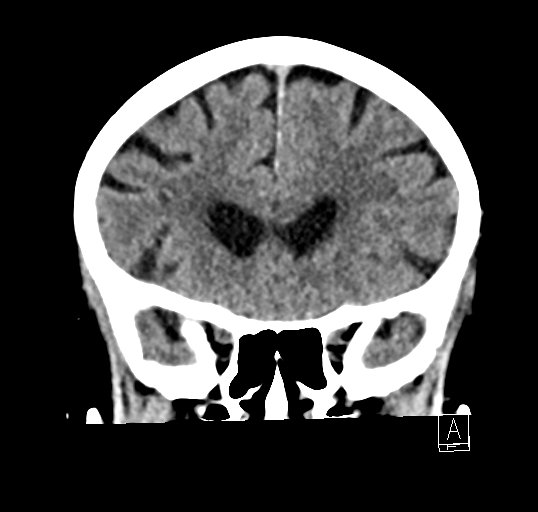 Cerebral venous infarction with hemorrhage (Radiopaedia 65343-74381 Coronal non-contrast 15).jpg