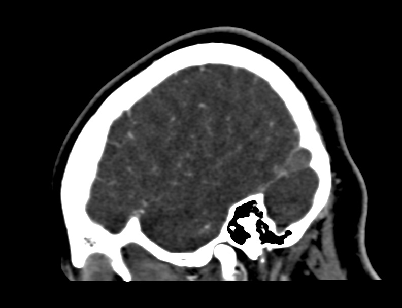 Cerebral venous sinus thrombosis (Radiopaedia 59224-66646 Sagittal C+ delayed 57).jpg
