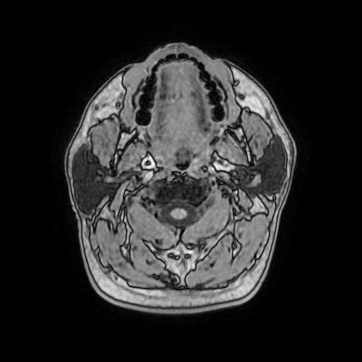 File:Cerebral venous thrombosis with secondary intracranial hypertension (Radiopaedia 89842-106957 Axial T1 10).jpg