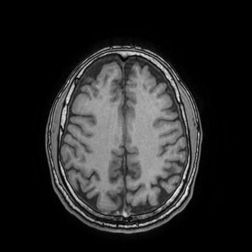 Cerebral venous thrombosis with secondary intracranial hypertension (Radiopaedia 89842-106957 Axial T1 123).jpg
