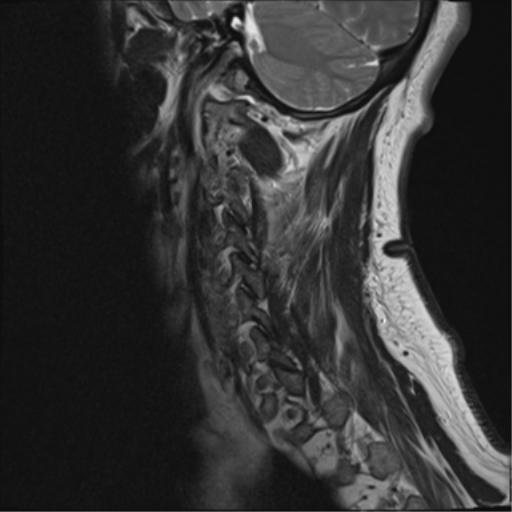 File:Cervical canal stenosis due to ossification of the posterior longitudinal ligament (Radiopaedia 47260-51824 Sagittal T2 15).png