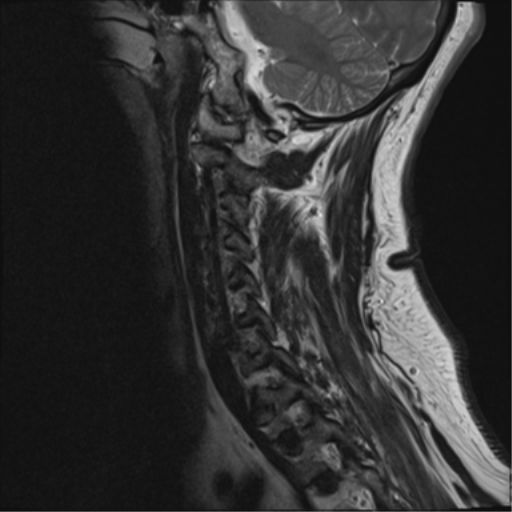 File:Cervical canal stenosis due to ossification of the posterior longitudinal ligament (Radiopaedia 47260-51824 Sagittal T2 3).png