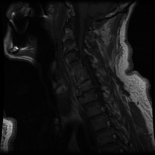 File:Cervical canal stenosis with cord compression (Radiopaedia 34114-35374 Sagittal T1 9).png