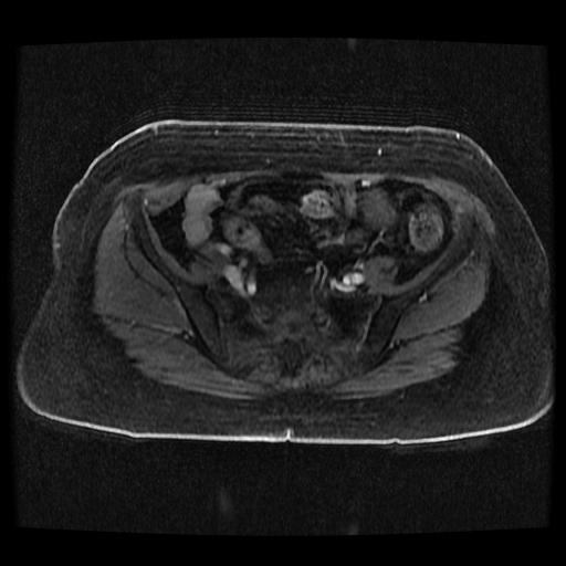 File:Cervical carcinoma (Radiopaedia 70924-81132 Axial T1 C+ fat sat 246).jpg