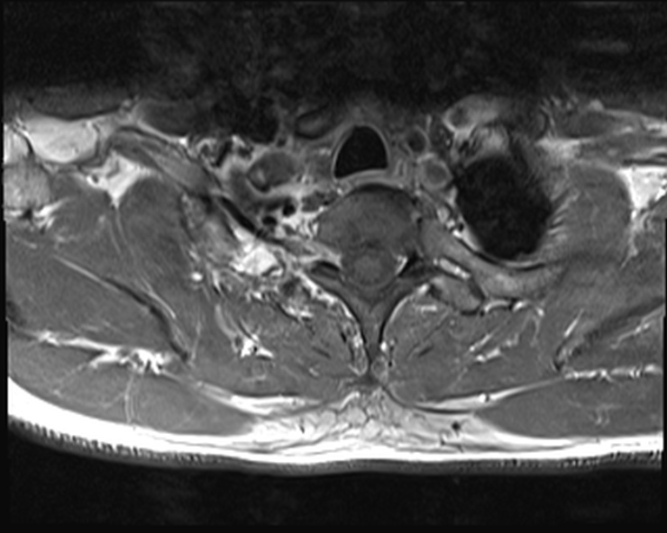 File:Cervical disc extrusion (Radiopaedia 53950-60077 Axial T1 C+ fat sat 30).jpg